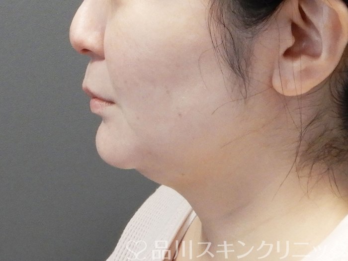 症例NO.73440のAFTER写真