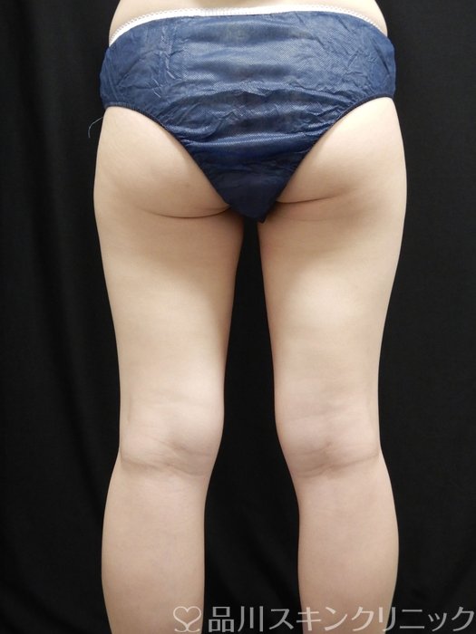 症例NO.74681のAFTER写真