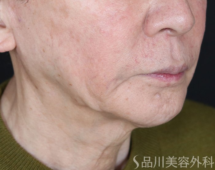 症例NO.73902のBEFORE写真