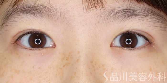 症例NO.70262のAFTER写真