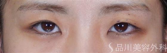 症例NO.59612のBEFORE写真