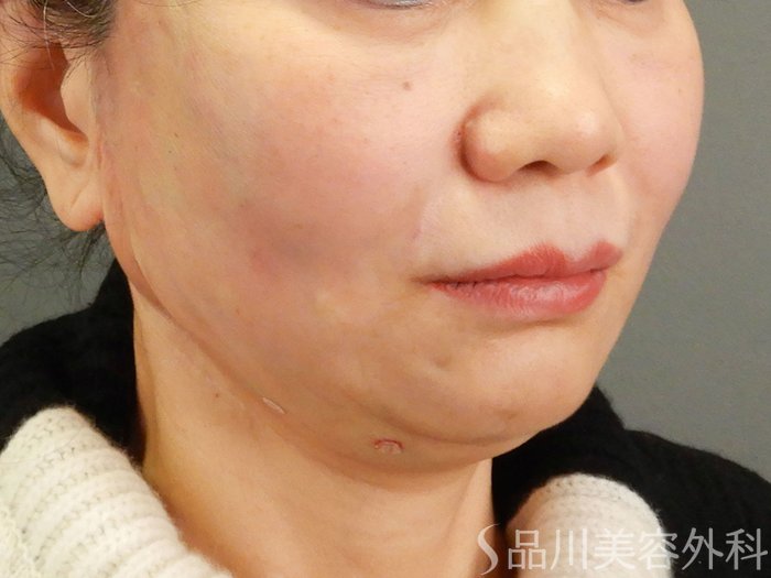 症例NO.62873のAFTER写真