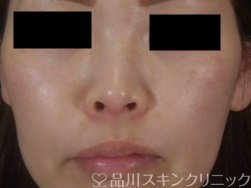 症例NO.73968のBEFORE写真