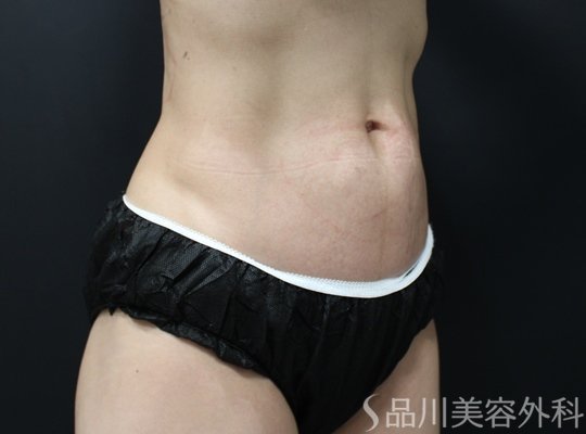 症例NO.75217のBEFORE写真