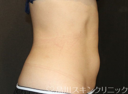 症例NO.71459のAFTER写真