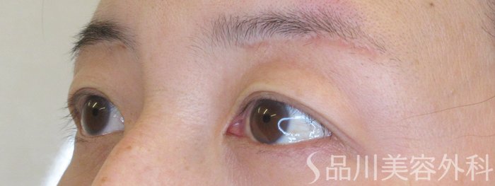 症例NO.70827のAFTER写真
