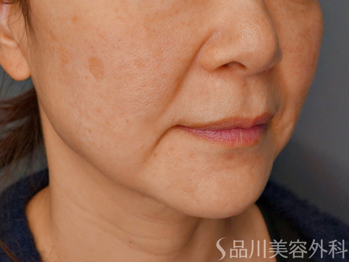 症例NO.73270のBEFORE写真