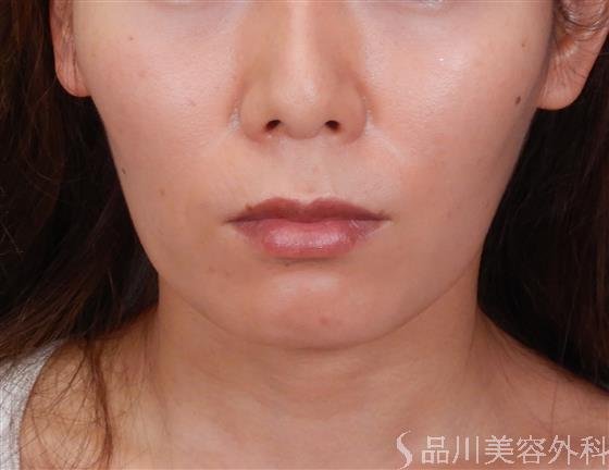 症例NO.58963のBEFORE写真
