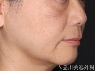 症例NO.75196のAFTER写真
