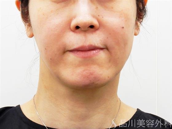 症例NO.51930のBEFORE写真