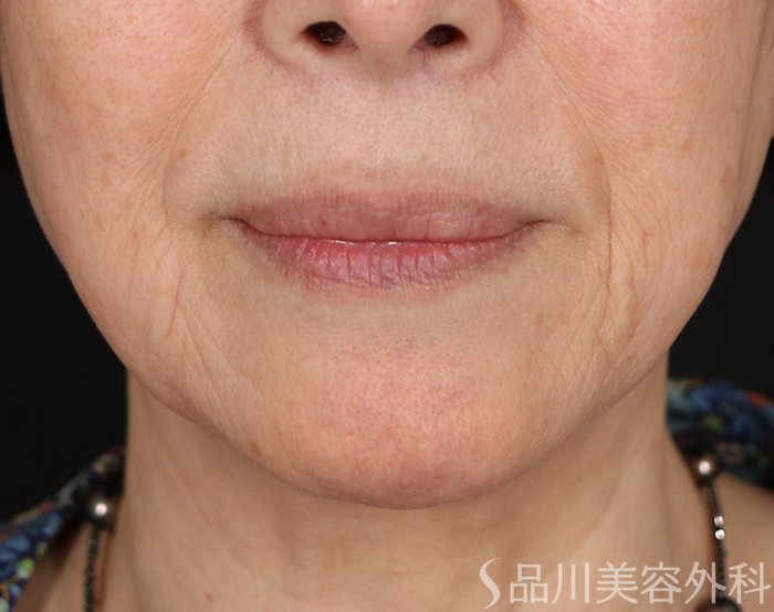 症例NO.71862のBEFORE写真
