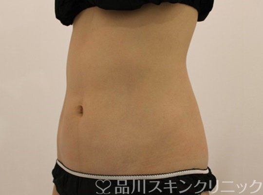 症例NO.71858のAFTER写真
