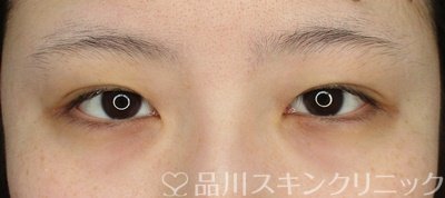 症例NO.65410のBEFORE写真
