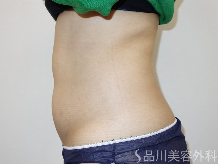 症例NO.73687のAFTER写真