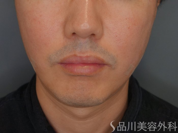 症例NO.75308のAFTER写真