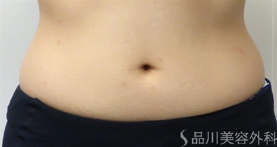 症例NO.46426のBEFORE写真