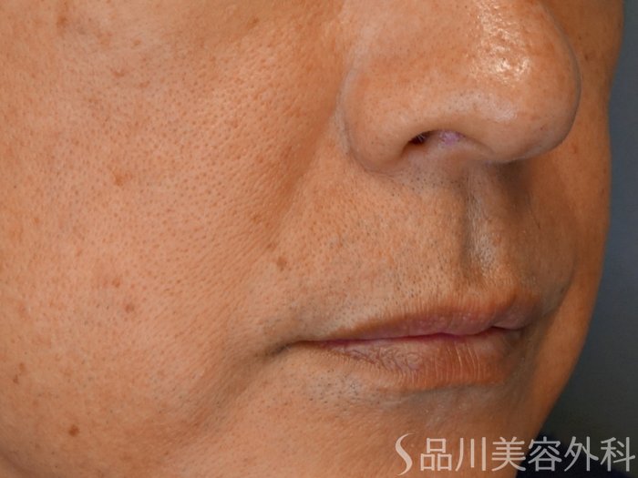 症例NO.67833のBEFORE写真