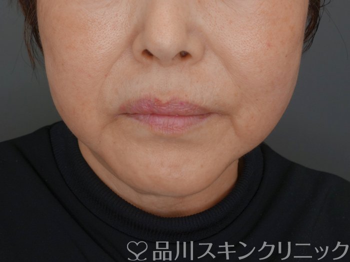 症例NO.72035のAFTER写真