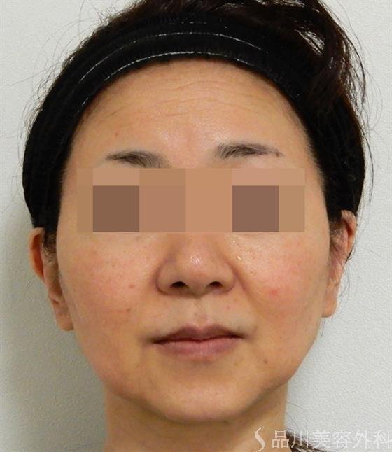 症例NO.38737のBEFORE写真