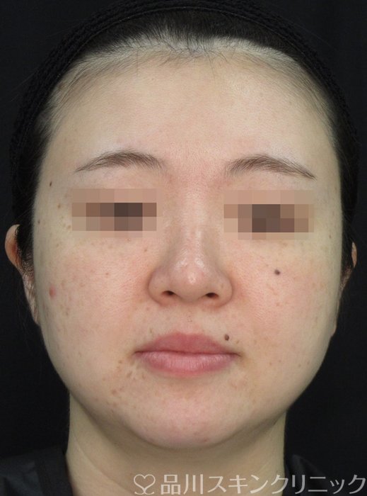 症例NO.72175のAFTER写真