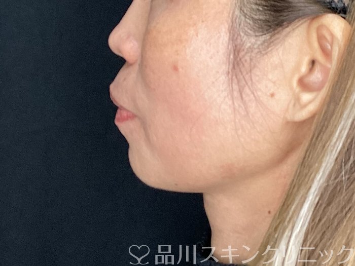 症例NO.72661のBEFORE写真