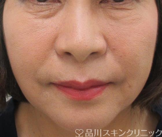 症例NO.26429のAFTER写真