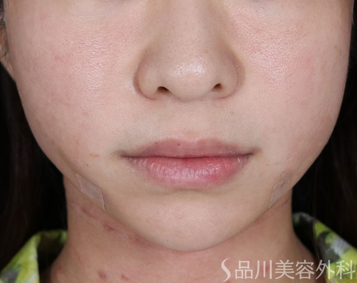 症例NO.71162のAFTER写真