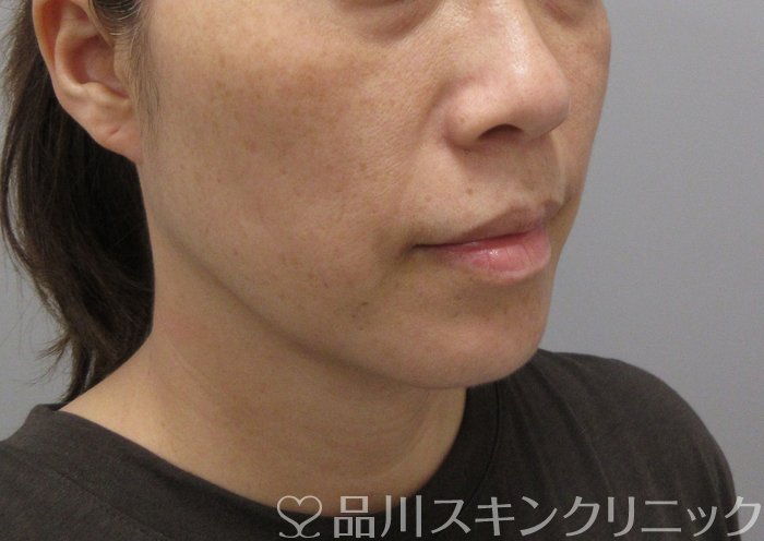 症例NO.71729のBEFORE写真