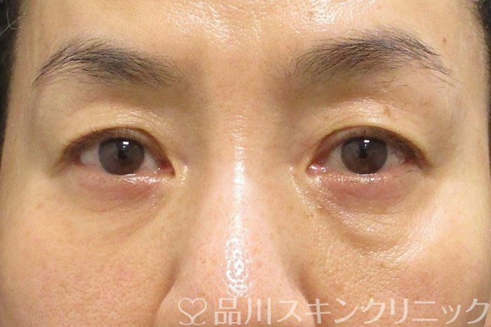 症例NO.70148のAFTER写真
