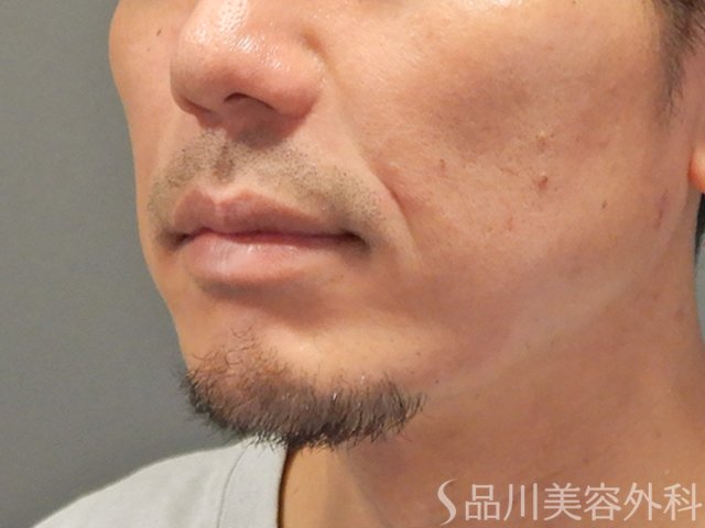 症例NO.73372のBEFORE写真