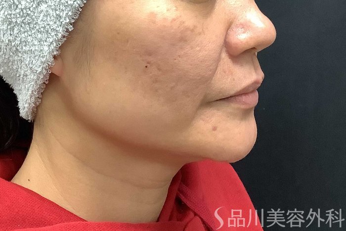 症例NO.69667のBEFORE写真