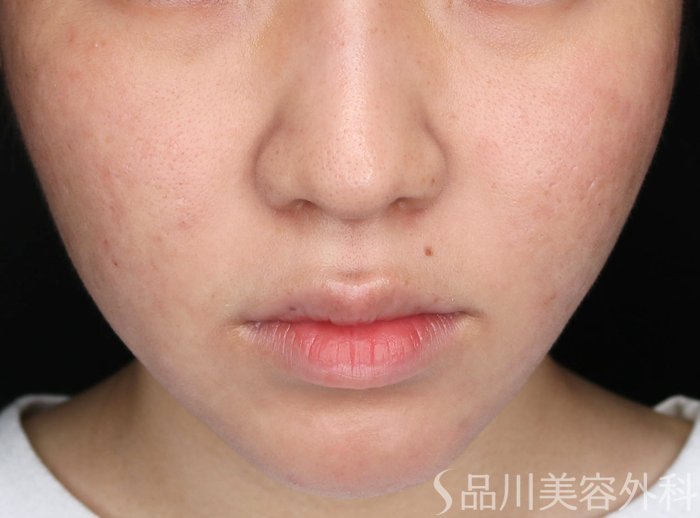 症例NO.64978のBEFORE写真