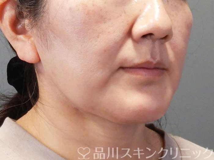 症例NO.74189のBEFORE写真