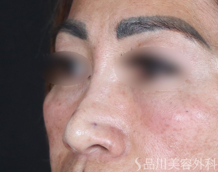 症例NO.72598のAFTER写真