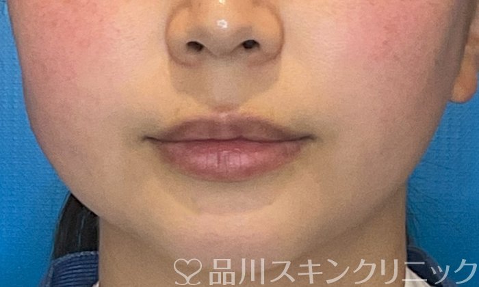 症例NO.74794のBEFORE写真