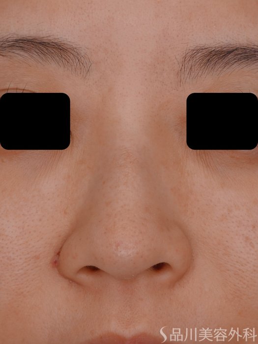 症例NO.73608のBEFORE写真