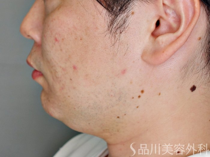 症例NO.73543のBEFORE写真