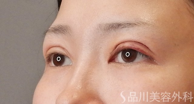 症例NO.75158のAFTER写真