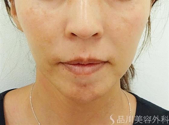 症例NO.36174のAFTER写真