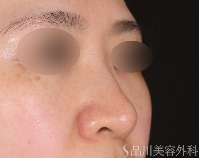 症例NO.72615のBEFORE写真