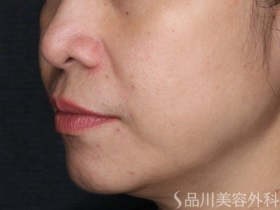 症例NO.74308のAFTER写真