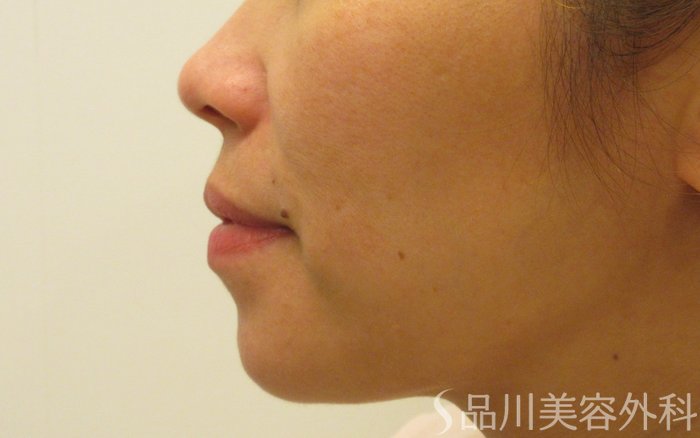 症例NO.70381のBEFORE写真