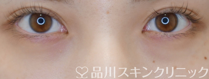症例NO.71592のBEFORE写真