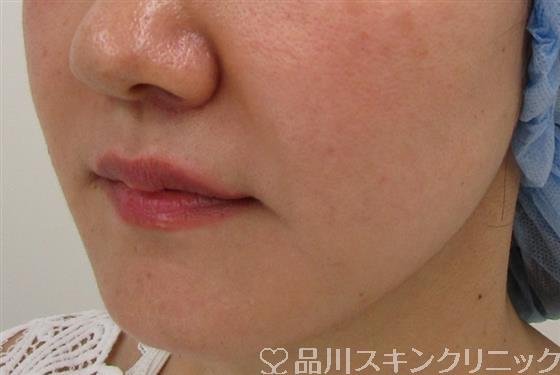 症例NO.35438のAFTER写真