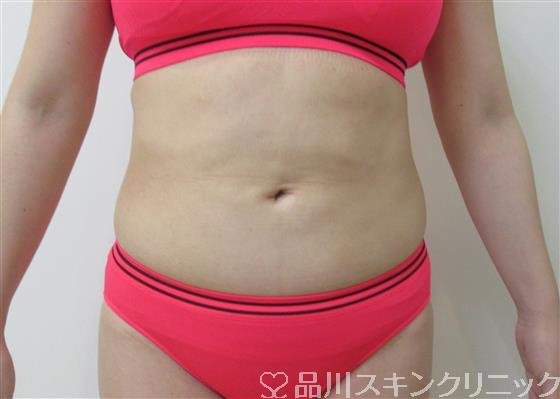 症例NO.26551のAFTER写真