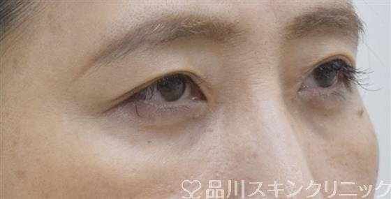 症例NO.54220のAFTER写真