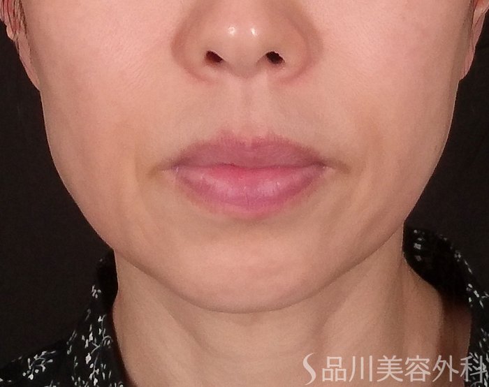 症例NO.69314のBEFORE写真