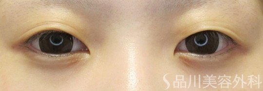 症例NO.66535のBEFORE写真