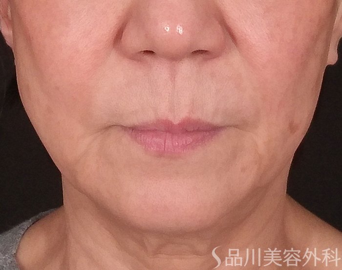 症例NO.69847のBEFORE写真