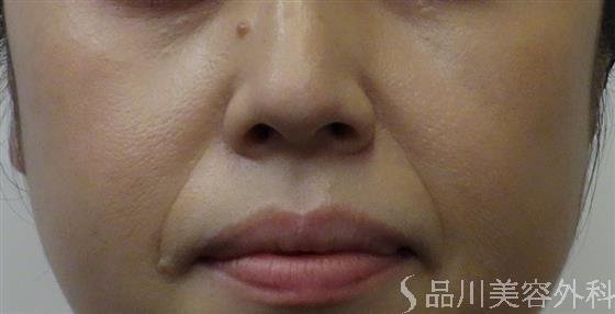 症例NO.52017のBEFORE写真